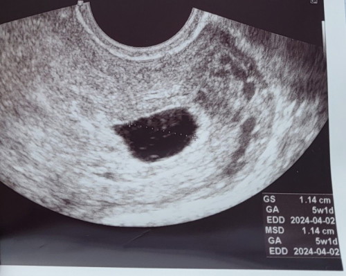 5 weeks 1 day walang makitang baby normal po ba to?