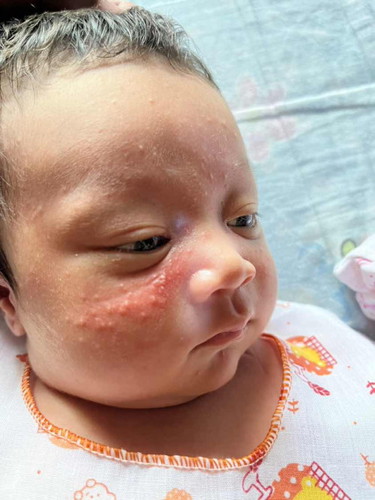 ผื่นขึ้นหน้า
ลูกเป็นผื่นที่หน้า ตามภาพค่ะแบบนี้เกิดจากอะไรคะ ควรจะรักษายังไงดี