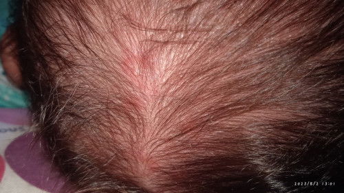 Bun ini kenapa ya di kepala anakku muncul ruam" merah qt