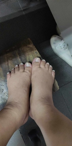 #อาการเท้าบวม