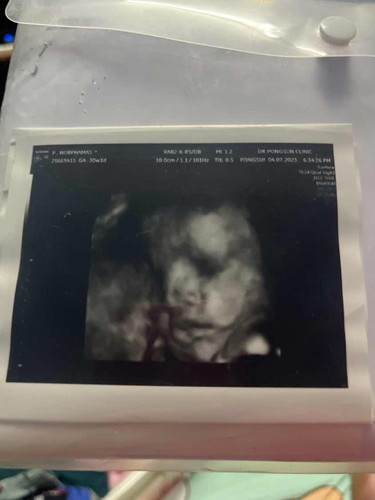 34w+2d บ้านนี้หมอกำหนดผ่า ขอประสบการณ์จากแม่ๆที่ผ่าคลอดทีค่าา🙏🏻😂 เริ่มกลัวแล้ว