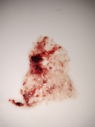 Period tp ada ketulan kulit nipis.