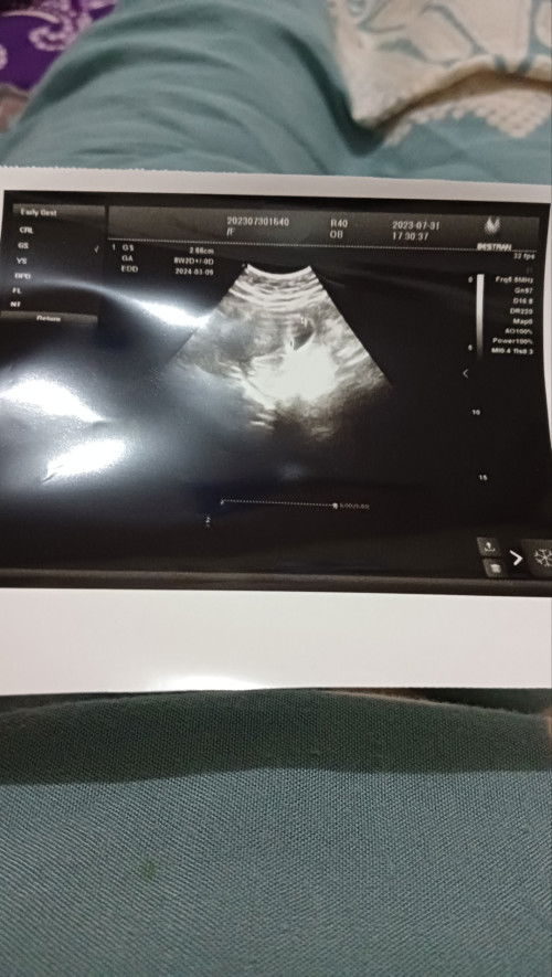 Usia kandungan di aplikasi dengan usg berebda dan saat di usg baru terlihat kantong janin