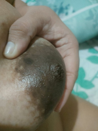 Crack nipple
Pls help, I'm 17 wks preggy and nagcrack ang nipples ko na may black something, WTD po?
