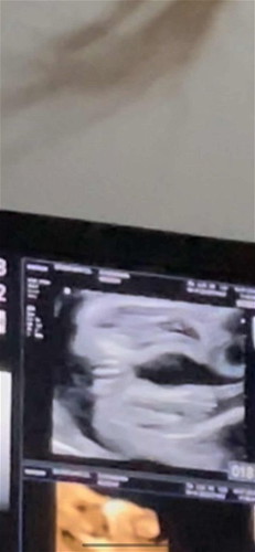 แม่ๆท่านไหนซาวด์ได้ลูกผู้หญิงบ้างคะ? อยากรู้ว่าเป็นแบบนี้ไหม??