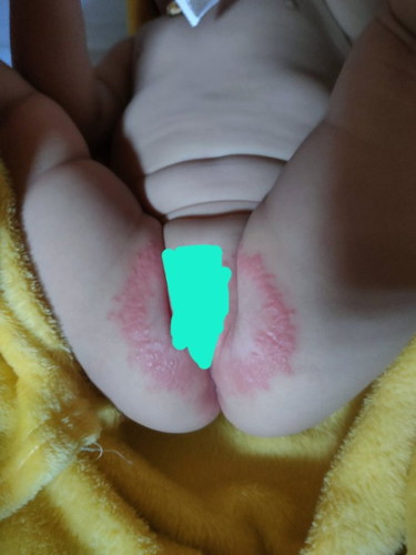 Rashes ni baby