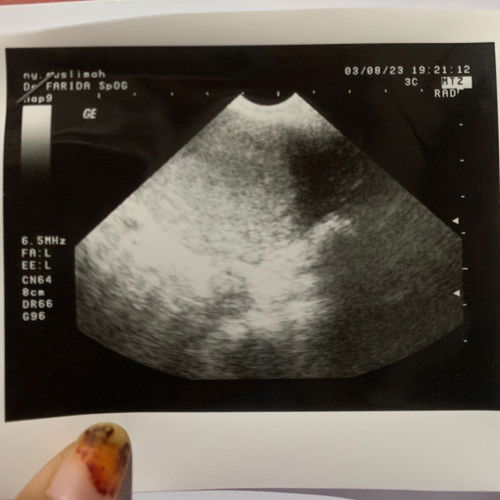 Belum terlihat kantung Janin apakah normal?