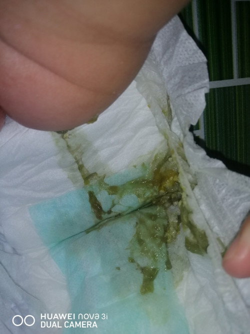 Normal ke najis anak saya mcm nii? Dia minum susu formula sebab susu badan kering suda
