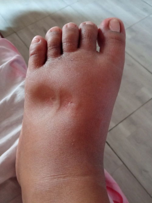 Kaki bengkak setelah lahiran