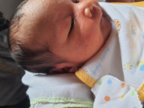 Baby acne....