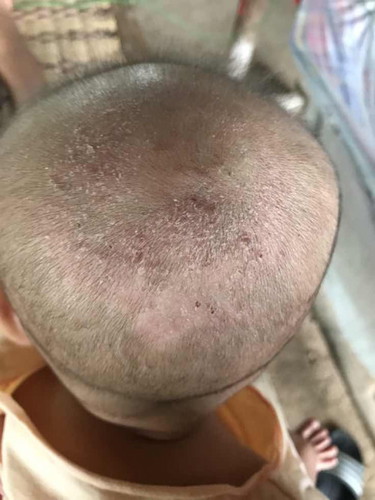 หัวน้องเป็นแบบนี้เกิดจากอะไรค่ะ แล้วมีวิธีรักษายังไงบ้างค่ะ