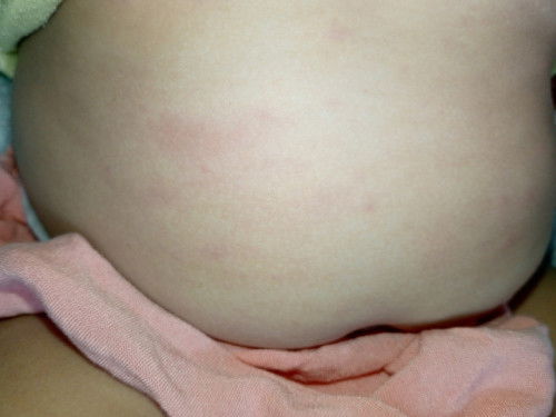 Normal ba ito sa kagat ng langgam?