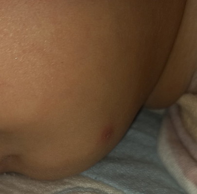 แบบนี้เป็นอีสุกอีใสรึป่าวค่ะ