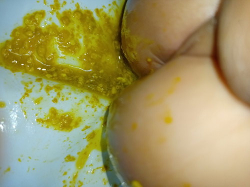 Matubig na poopoo ni baby