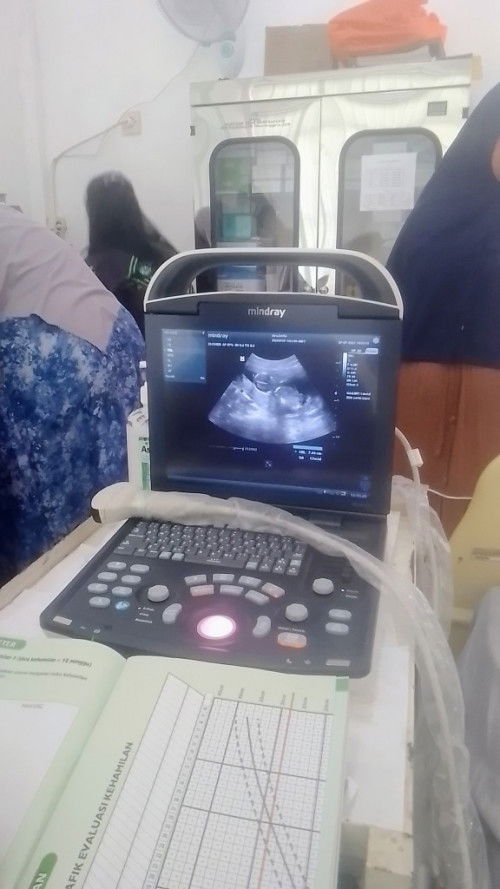 USG pertama usia 13w3d