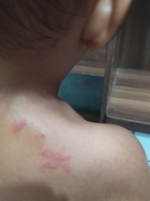 Ini kenapa ya bund.. muncul merah di kulit nya