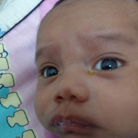 Tahi mata banyak