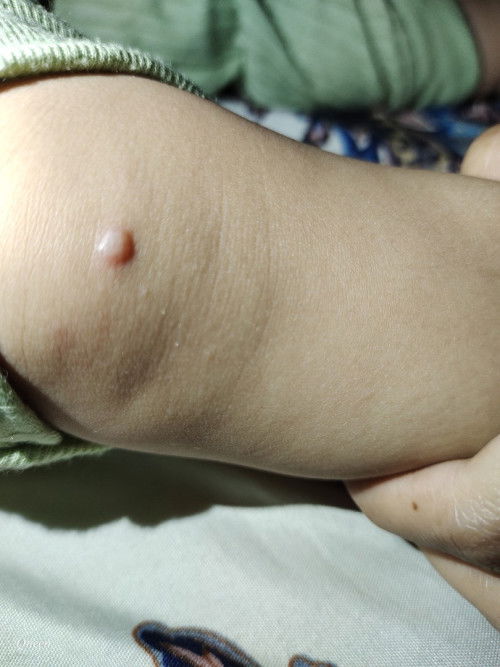 Bintik di lutut dan jari