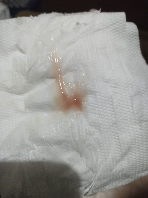 39+1วิค แบบนี้ใช่มูกเลือดไหมค่ะ