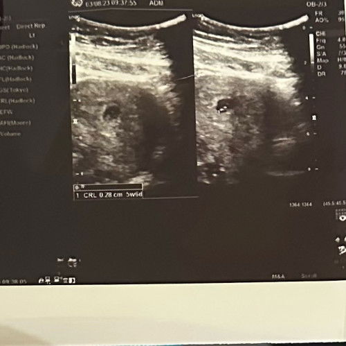 Usg 6 minggu 5 hari