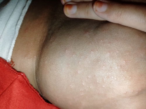 Bintin bintik pada bokong bayi