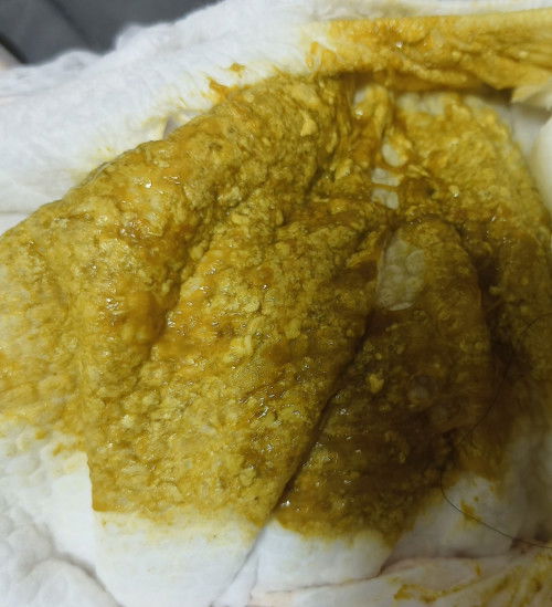 ใช่มูกเลือดไหมคะ?