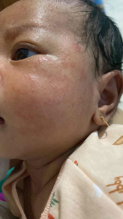 bintik merah semuka bayi