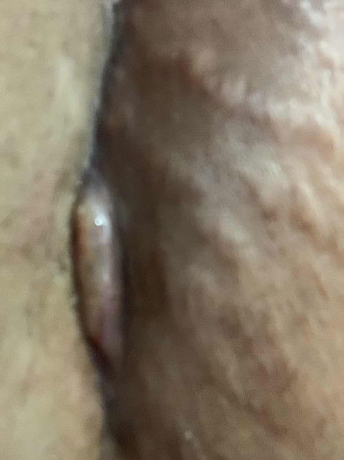 Bekas jaitan sc ada yg lepas 2cm