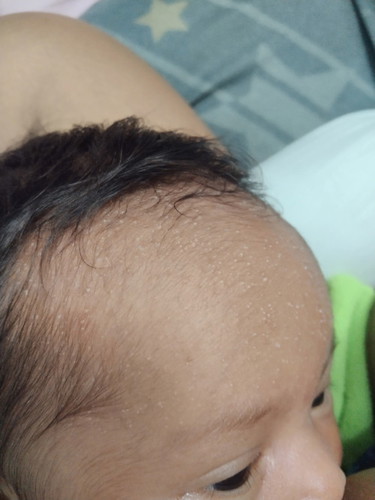 อันนี้คือไรค่ะ ผดร้อนหรือเปล่า