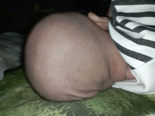 Kepala bayi datar sebelah