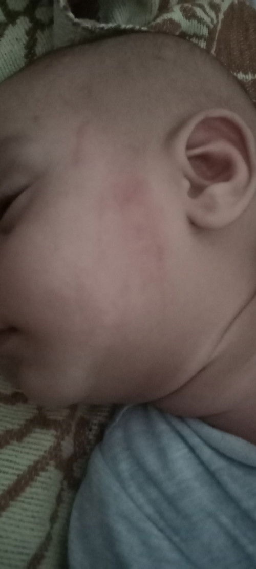 Merah2 di pipi dan agak sedikit kasar