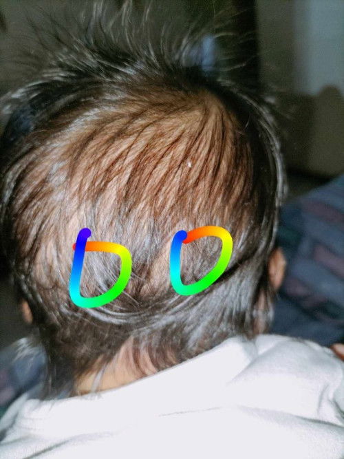 Matigas na Bukol sa ulo ni baby. Pero hindi naman nauntog