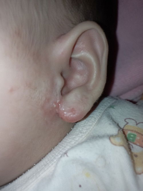 ติ่งหูมีน้ำเหลืองออก