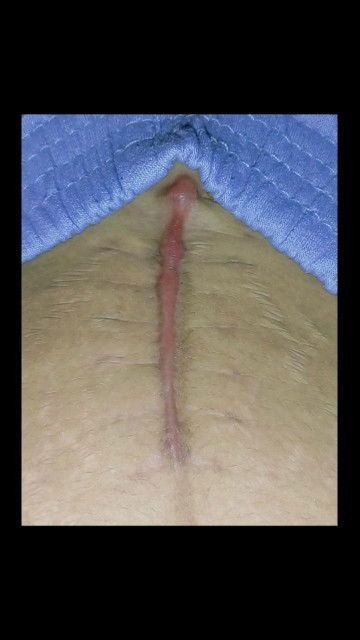 แม่ผ่าคลอด