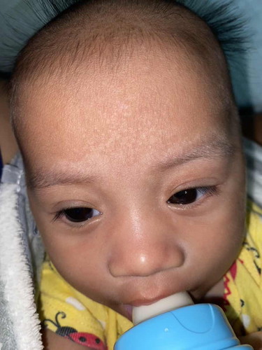 ปรึกษาแม่ๆเรื่องผิวลูก