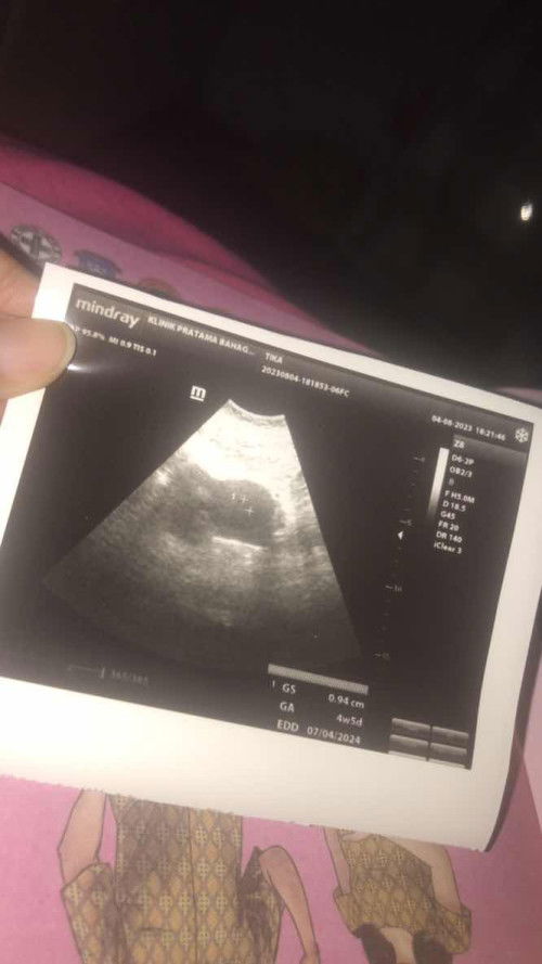 Keluar flek di usia 7week