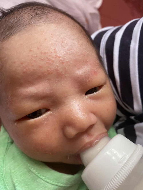 ผดขึ้นแบบนี้คือผดอะไรคะ