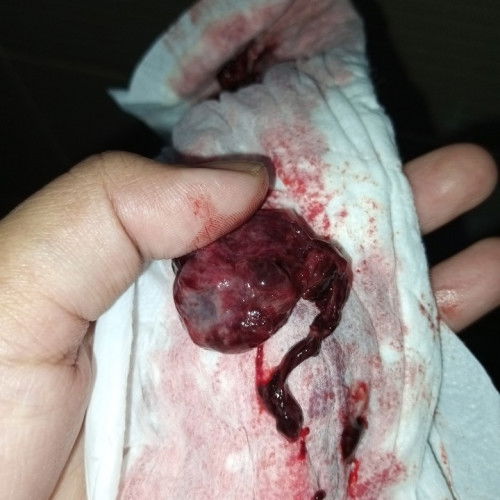 Magkano po mag pa-raspa sa public hospital lalo na kapag hindi ka na active payer ng Philhealth