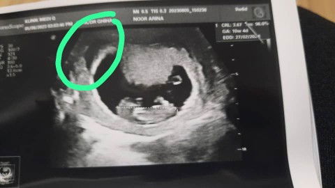 Bleeding dalam Rahim