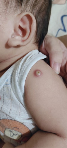 Có cần chích ra rồi nặn mủ ko các mom? Bé nhà e sưng to quá ak