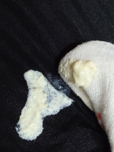 Jeluak normal atau tidak