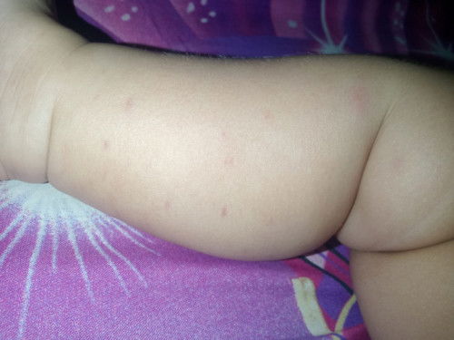 Bercak kemerahan di kulit betis kaki bayi 4 bulan
