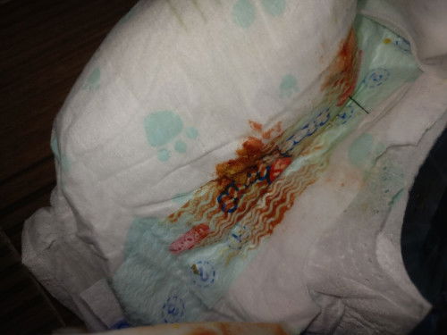 Dugo sa poop ni baby