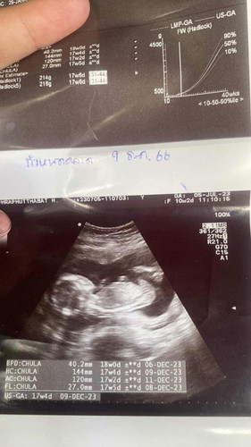 อัลตราซาวด์ 4เดือน