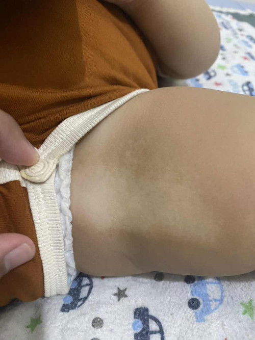 Putih-putih seperti panu dikulit