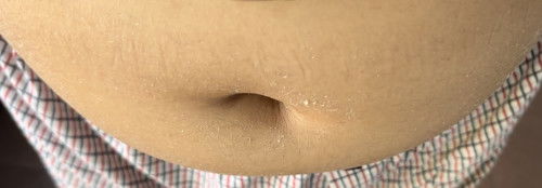 14-15 mgg mengelupas kulit