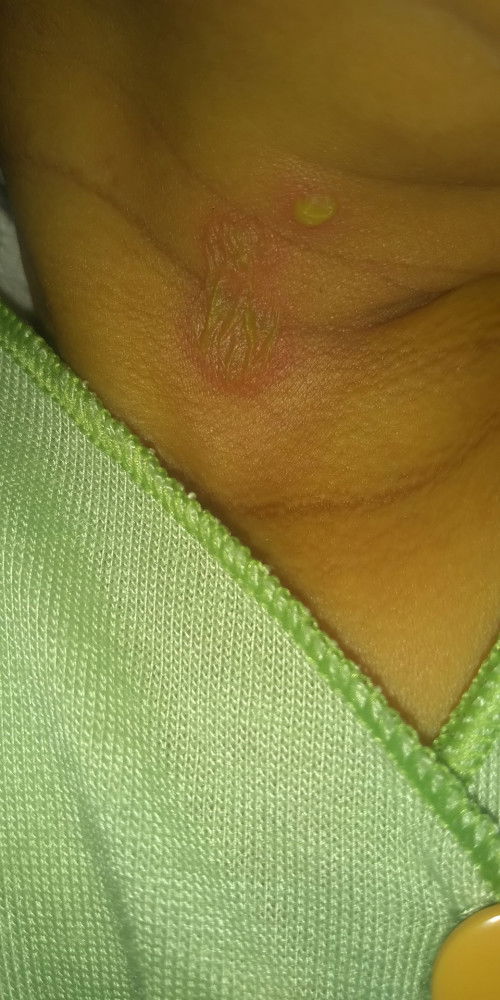 Ruam merah pada bayi