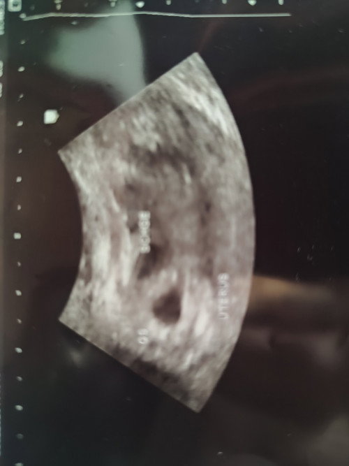 Magttanong lang po kmg mababa po b ang chance n mbuhay ang baby kpg ng bbleeding?