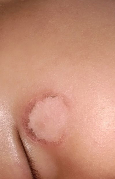 Anak seperti luka kebakar