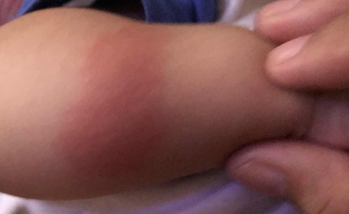 kagat po ba ito ng langgam o lamok kay baby? masyado po kasing malaki😿 pantal po sya medyo matigas